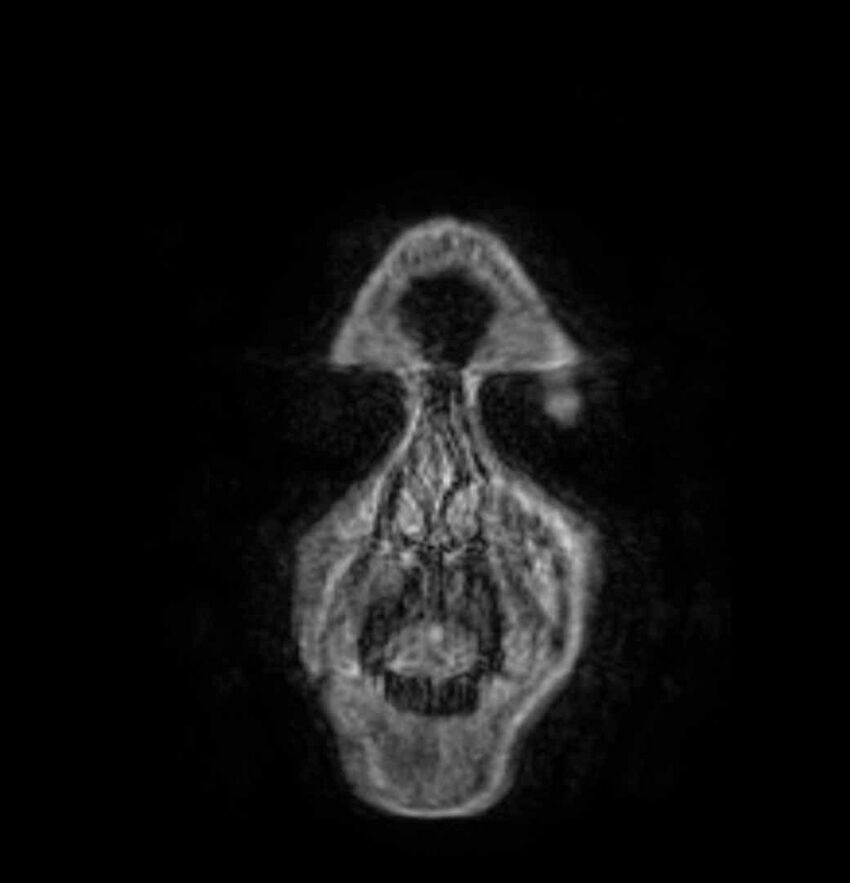 Arachnoid cyst- extremely large (Radiopaedia 68741-78451 Coronal T1 C+ 3).jpg