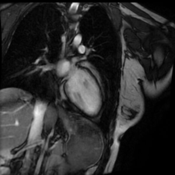 File:Arrhythmogenic right ventricular cardiomyopathy (Radiopaedia 87505-103850 2ch (LV) Cine SSFP 60).jpg