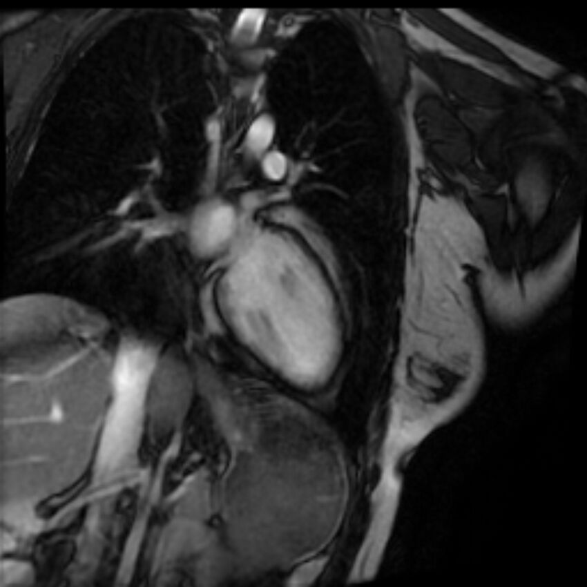 Arrhythmogenic right ventricular cardiomyopathy (Radiopaedia 87505-103850 2ch (LV) Cine SSFP 60).jpg