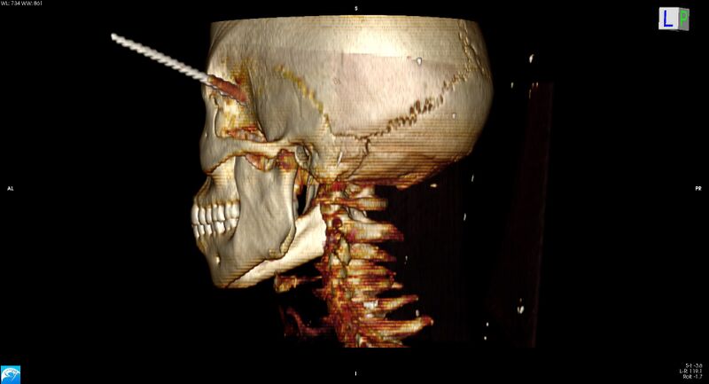 File:Arrow injury to the head (Radiopaedia 75266-86388 3D horizontal 28).jpg