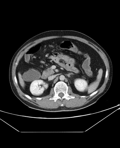 File:Arterial occlusive mesenteric ischemia (Radiopaedia 84641-100054 A 44).jpg