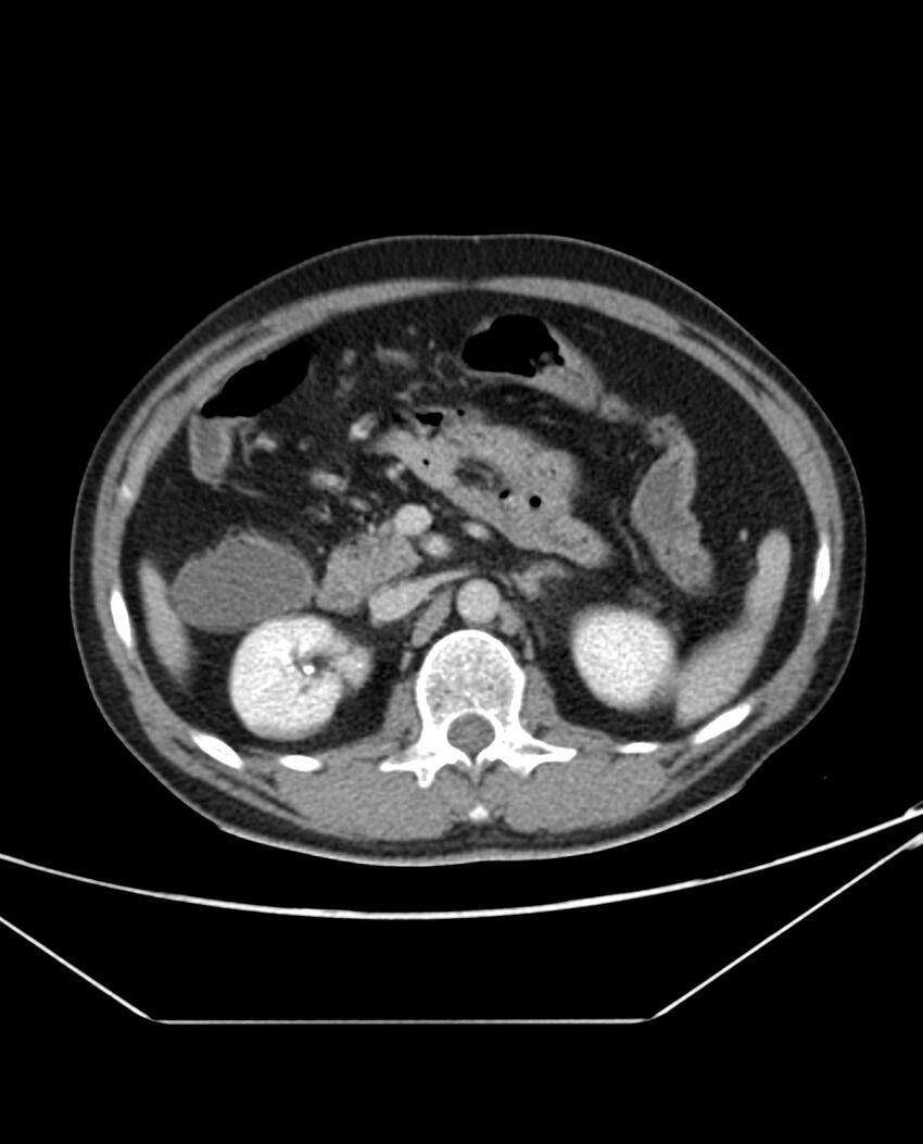 Arterial occlusive mesenteric ischemia (Radiopaedia 84641-100054 A 44).jpg