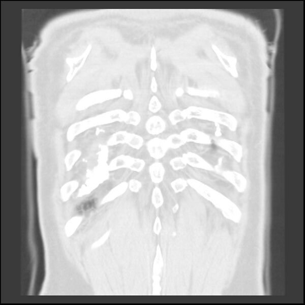 File:Asbestos-related pleural plaques (Radiopaedia 39069-41255 Coronal lung window 6).jpg