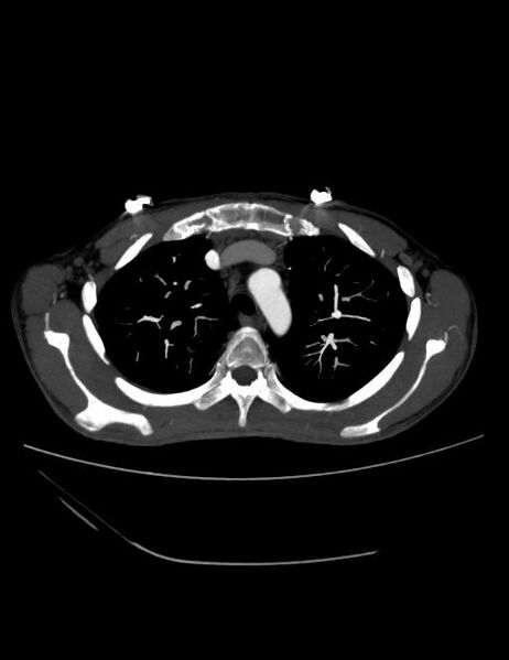 File:Ascending aortic pseudoaneurysm (Radiopaedia 28638-28910 A 5).jpg