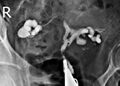 Asherman syndrome and bilateral hydrosalpinges (Radiopaedia 85444-101081 B 1).jpg