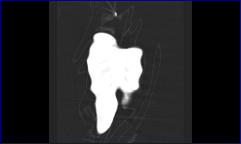 File:Aspergilloma (Radiopaedia 20788-20701 Coronal lung window 1).jpg