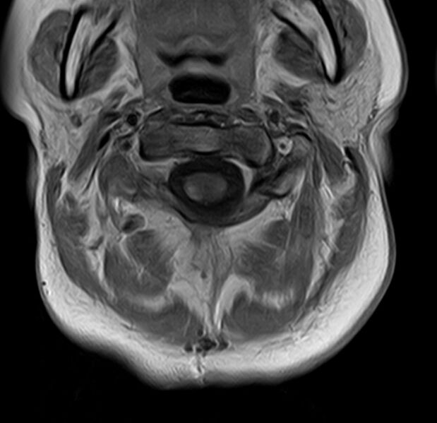 File:Astrocytoma - spinal cord (Radiopaedia 69769-79758 Axial T1 C+ 4).jpg
