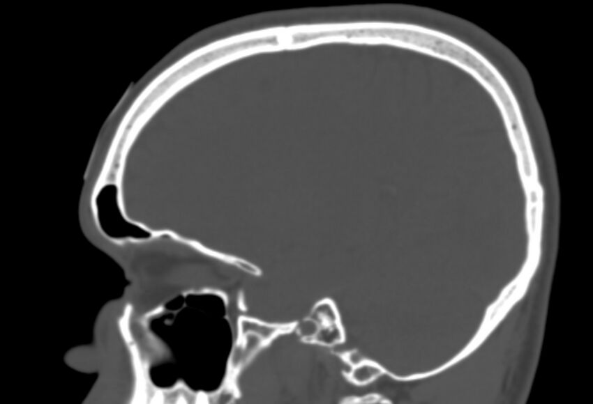 Asymptomatic occipital spur (Radiopaedia 87753-104201 Sagittal bone window 107).jpg