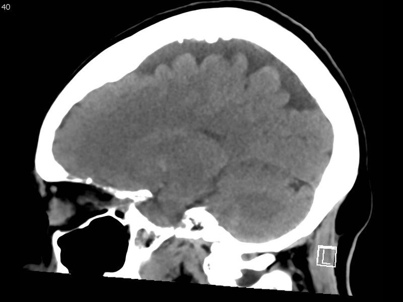 File:Atypical meningioma - intraosseous (Radiopaedia 64915-73867 C 38).jpg