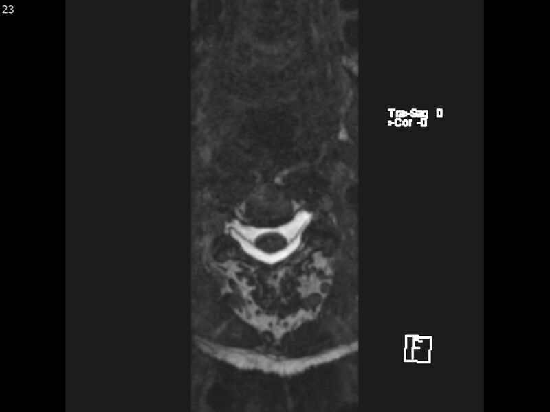 File:Atypical meningioma - intraosseous (Radiopaedia 64915-74572 Axial CISS 23).jpg