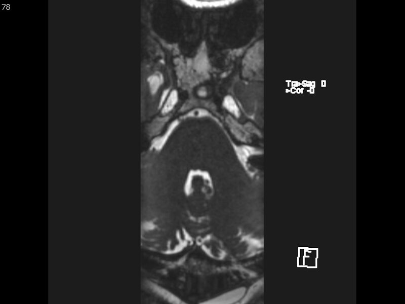 File:Atypical meningioma - intraosseous (Radiopaedia 64915-74572 Axial CISS 78).jpg