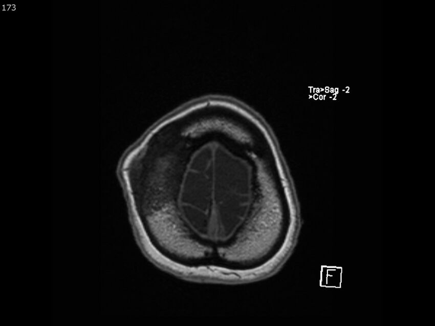 Atypical meningioma - intraosseous (Radiopaedia 64915-74572 Axial T1 173).jpg