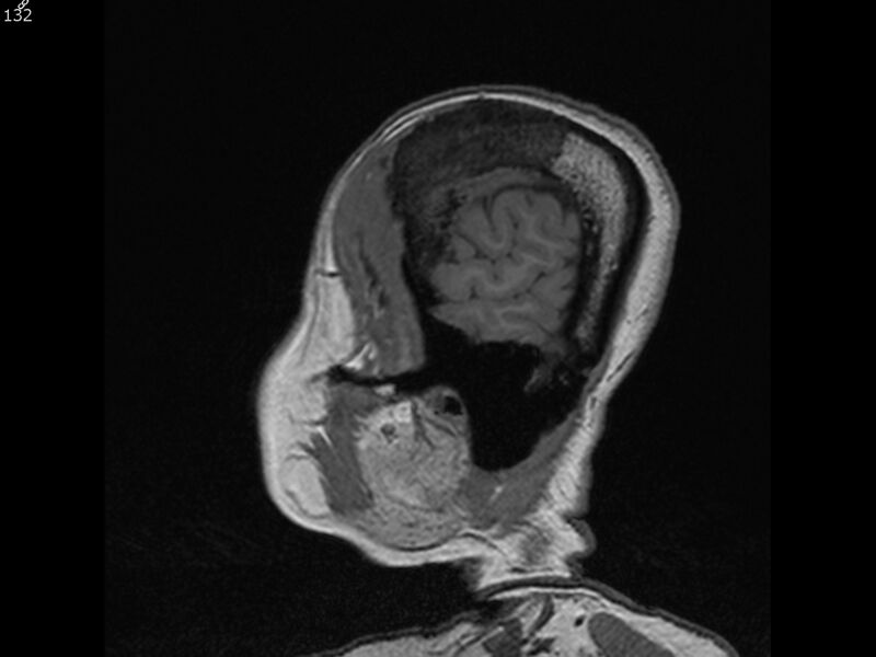 File:Atypical meningioma - intraosseous (Radiopaedia 64915-74572 Sagittal T1 132).jpg