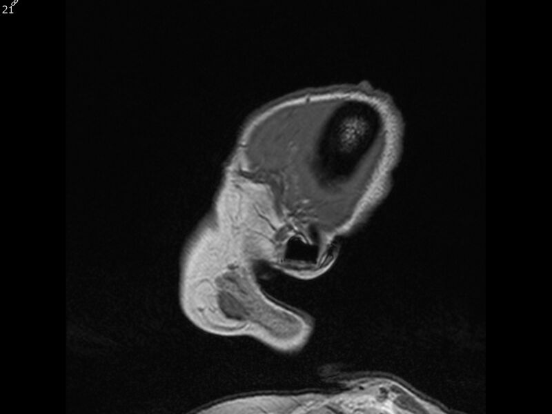 File:Atypical meningioma - intraosseous (Radiopaedia 64915-74572 Sagittal T1 21).jpg
