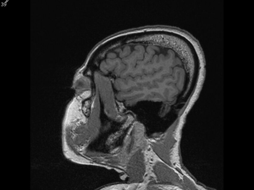 Atypical meningioma - intraosseous (Radiopaedia 64915-74572 Sagittal T1 39).jpg