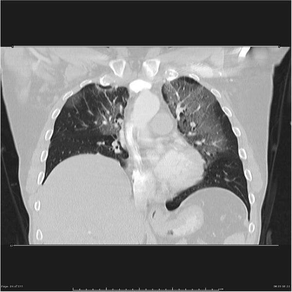 File:Atypical pneumonia - Q fever (Radiopaedia 21993-21989 C 17).jpg