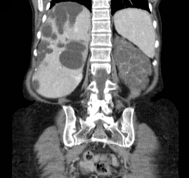 File:Autosomal dominant polycystic kidney disease (Radiopaedia 16777-16490 B 36).jpg