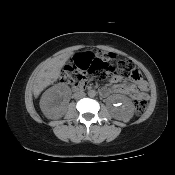File:Autosomal dominant polycystic kidney disease (Radiopaedia 23061-23093 Axial non-contrast 33).jpg