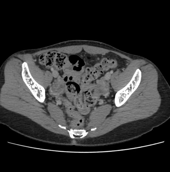 File:Autosomal dominant polycystic kidney disease - early onset (Radiopaedia 40734-43387 A 71).jpg
