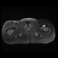 Avascular necrosis of the hip (Radiopaedia 29563-30067 Axial T2 fat sat 14).jpg