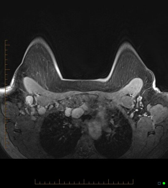 File:Axillary lymphadenopathy on breast MRI- yellow fever vaccination induced (Radiopaedia 19454-19483 Axial T1 C+ fat sat 18).jpg