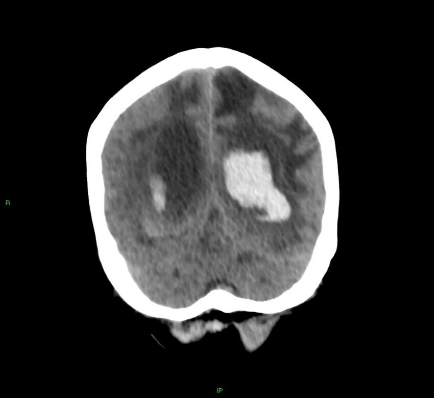 Basal ganglia hemorrhage (Radiopaedia 58766-65988 Coronal non-contrast 21).jpg