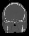 Base of skull fracture with bilateral Le Fort fractures (Radiopaedia 47094-51638 Coronal bone window 57).jpg