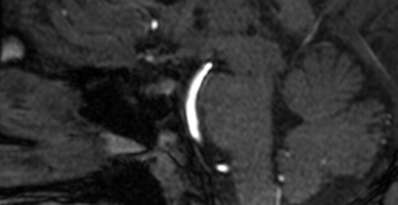 File:Basilar artery fenestration (Radiopaedia 74537-85455 Sagittal MRA TOF 15).jpg