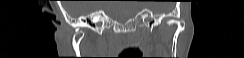 File:Basilar impression (Radiopaedia 52411-58522 Coronal bone window 69).jpg