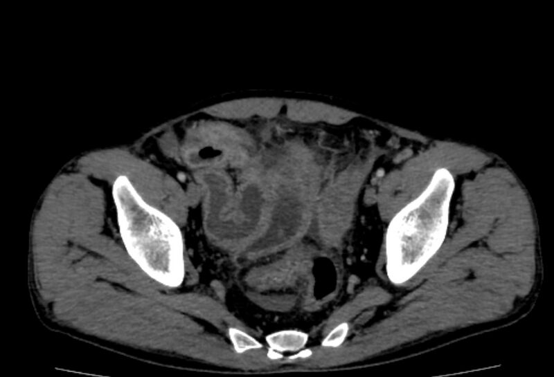 File:Behçet's disease- abdominal vasculitis (Radiopaedia 55955-62570 A 79).jpg