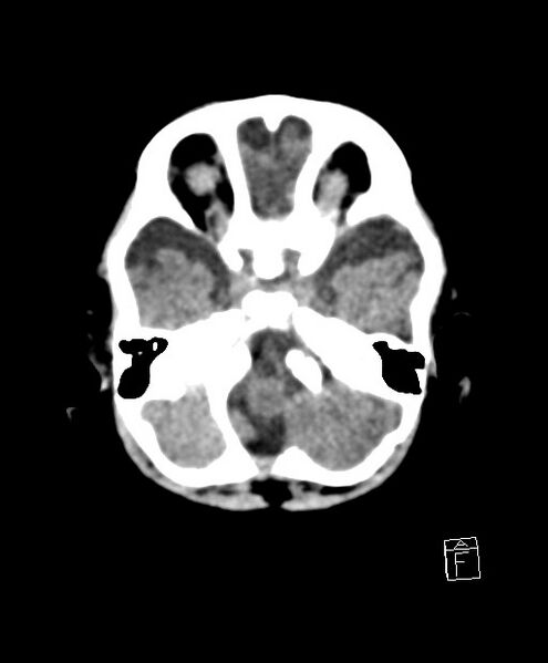 File:Benign enlargement of subarachnoid spaces in infancy (BESS) (Radiopaedia 87459-103795 Axial non-contrast 72).jpg