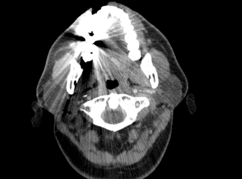 File:Benign mixed salivary tumor of the parotid gland (Radiopaedia 35261-36792 A 17).jpg