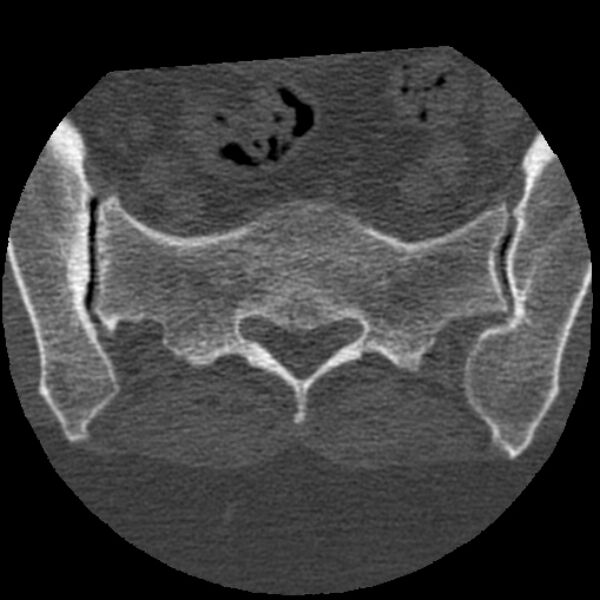 File:Bertolotti syndrome (Radiopaedia 24864-25128 Axial bone window 43).jpg