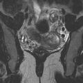Bicornuate uterus (Radiopaedia 24677-24949 Coronal T2 10).jpg