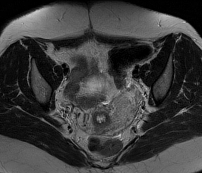 File:Bicornuate uterus (Radiopaedia 76407-88114 Axial T2 13).jpg