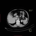 Bifid ureter (Radiopaedia 47604-52253 Axial C+ delayed 5).jpg