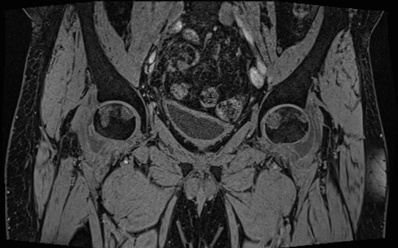 File:Bilateral avascular necrosis of femoral head (Radiopaedia 77116-89078 Coronal T2 we 57).jpg