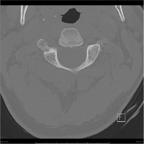 File:Bilateral cervical ribs (Radiopaedia 25868-26017 Axial bone window 15).jpg