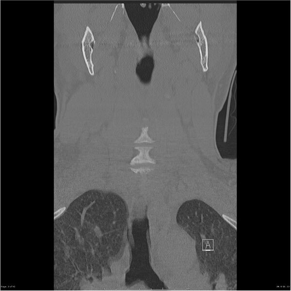File:Bilateral cervical ribs (Radiopaedia 25868-26017 Coronal bone window 3).jpg