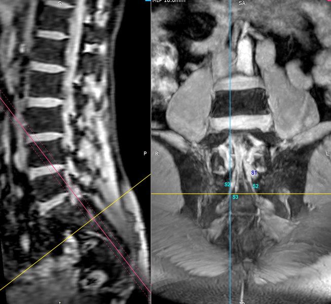 File:Bilateral conjoined nerve roots at different levels (Radiopaedia 73312-84064 WE MIP coronal 1).png