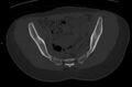 Bilateral mature cystic ovarian teratoma (Radiopaedia 88821-105592 Axial bone window 10).jpg