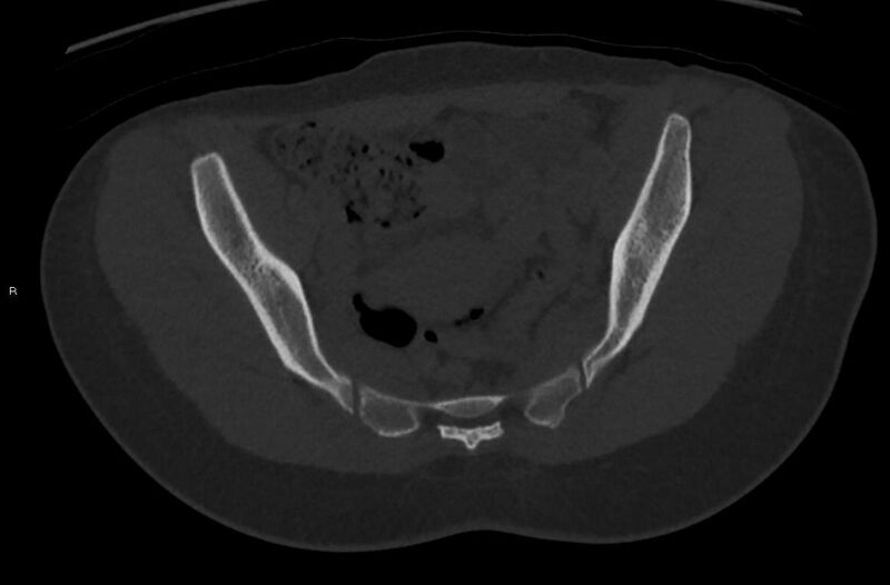 File:Bilateral mature cystic ovarian teratoma (Radiopaedia 88821-105592 Axial bone window 10).jpg