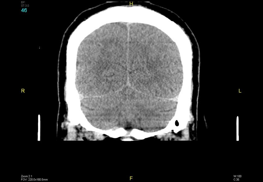 Bilateral medial medullary infarction (Radiopaedia 42220-45295 Coronal non-contrast 46).jpg