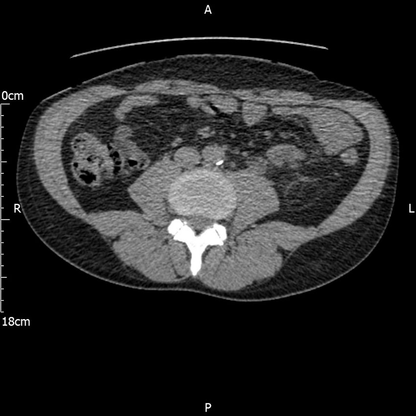 Bilateral medullary nephrocalcinosis with ureteric calculi (Radiopaedia 71269-81569 Axial non-contrast 70).jpg