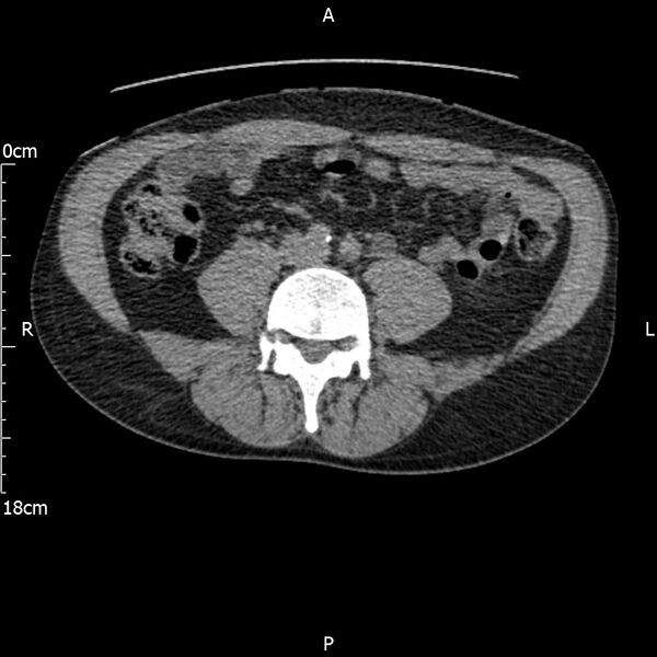 File:Bilateral medullary nephrocalcinosis with ureteric calculi (Radiopaedia 71269-81569 Axial non-contrast 78).jpg