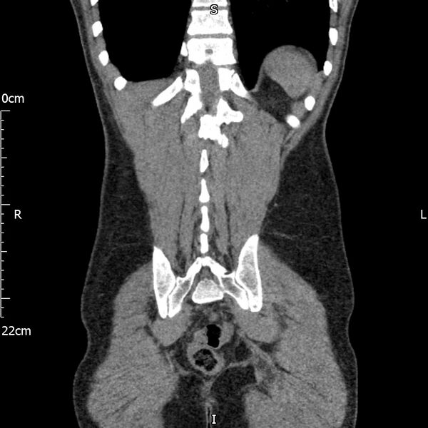 File:Bilateral medullary nephrocalcinosis with ureteric calculi (Radiopaedia 71269-81569 Coronal non-contrast 61).jpg