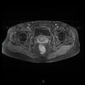 Bilateral ovarian fibroma (Radiopaedia 44568-48293 Axial T1 C+ fat sat 21).jpg