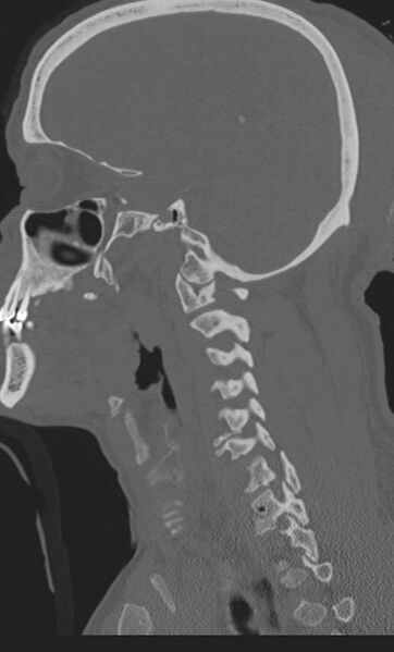 File:Bilateral perched facet joint (Radiopaedia 63149-71669 Sagittal bone window 48).jpg