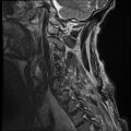 Bilateral perched facets with cord injury (Radiopaedia 45587-49714 Sagittal T2 3).jpg