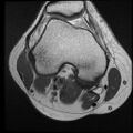 Bilateral popliteal artery entrapment (dynamic angiogram) (Radiopaedia 9420-10105 B 1).jpg